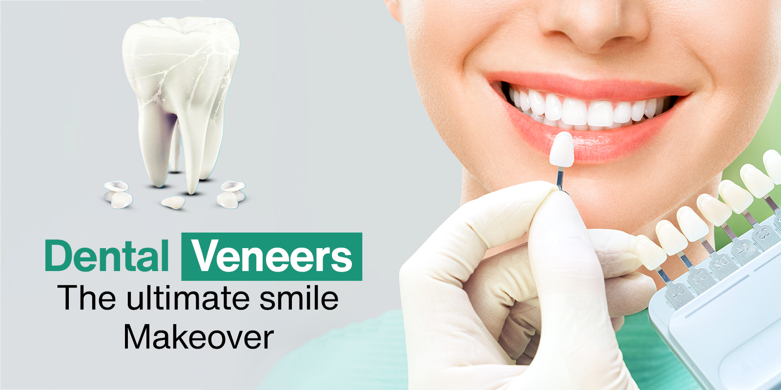 Dental Veneer